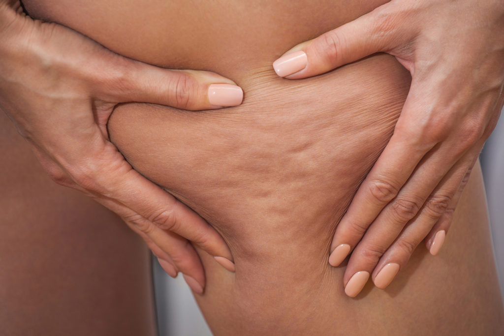 Woman pushes leg fat, showing dimples