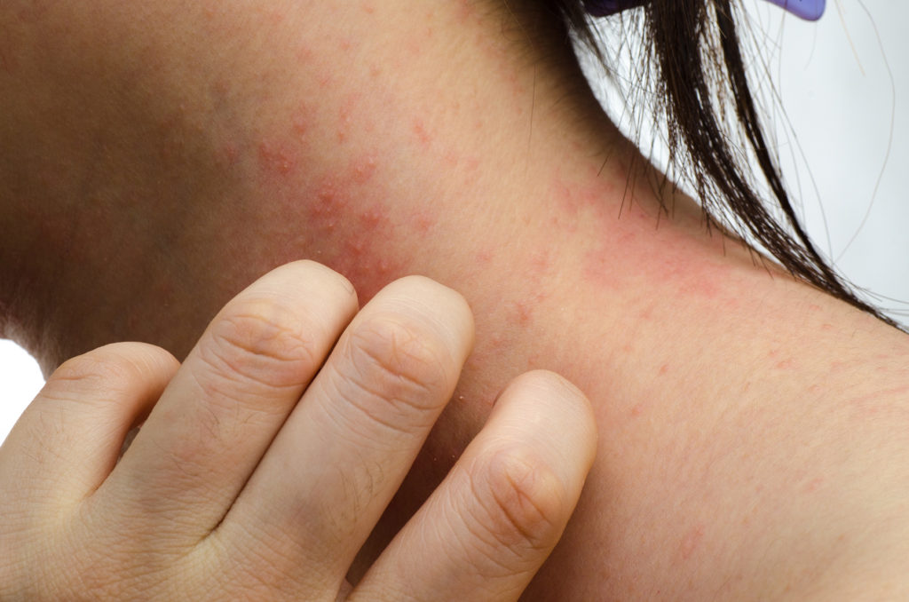 eczema skin on neck