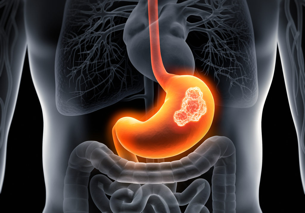 Xray of stomach cancer
