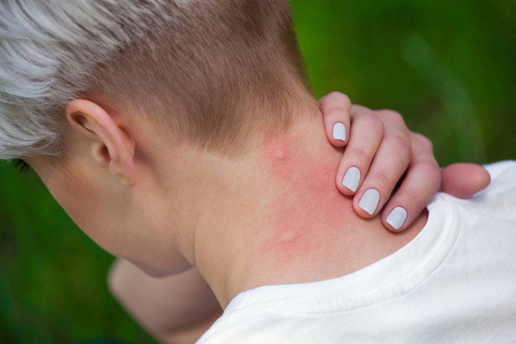 Mosquito bite to the neck .