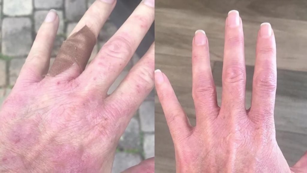 hands with chronic itch and eczema