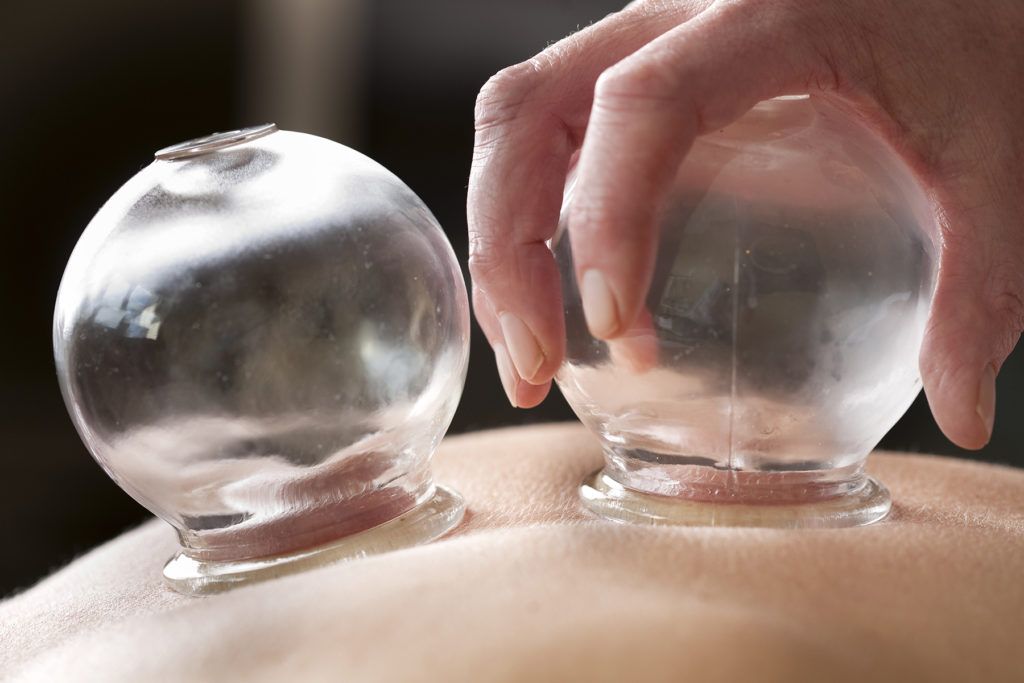 a close up view of cupping therapy
