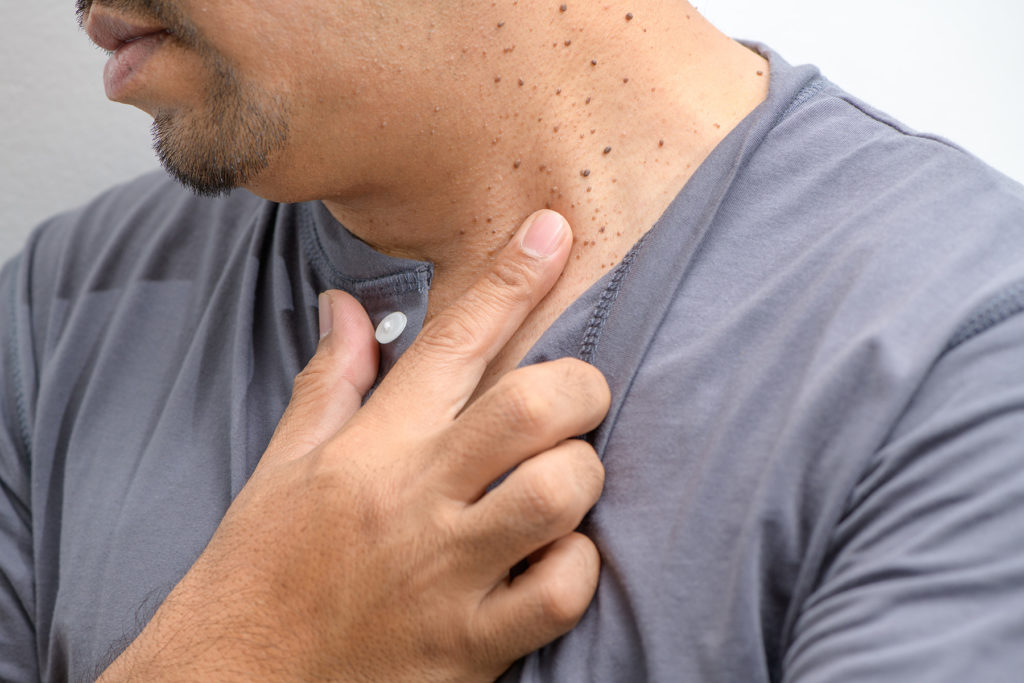 Man points to skin tags on his neck
